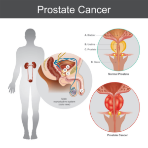 Prostate Cancer Screening