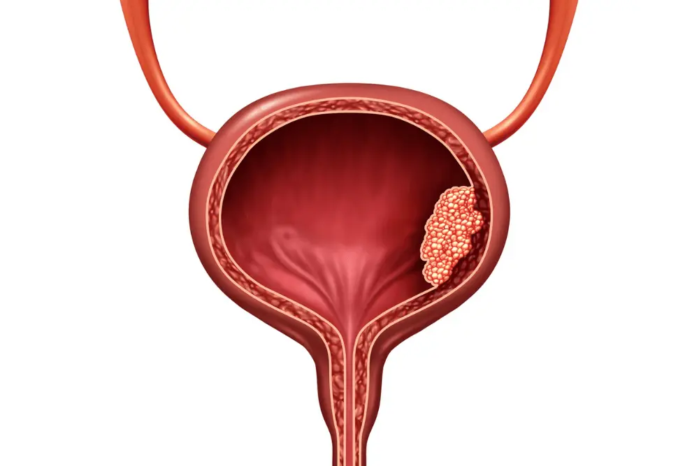 Bladder Cancer Screening Winnipeg