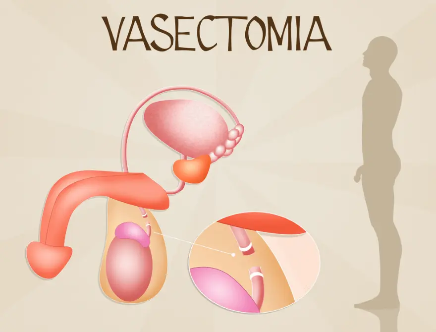 Vasectomy Reversal