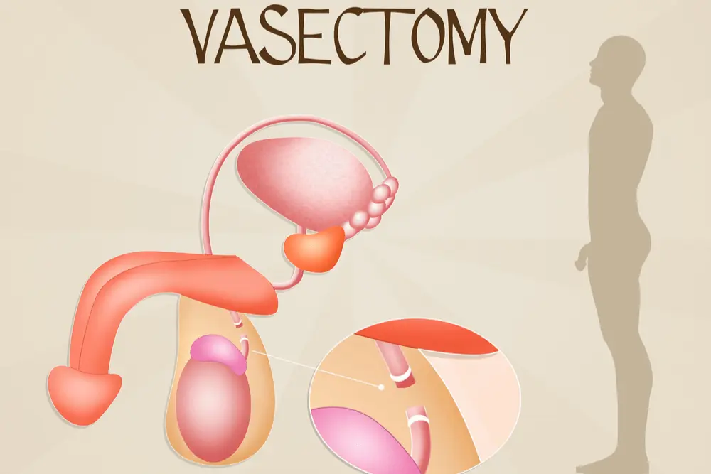 Vasectomy Sperm Retrieval Techniques