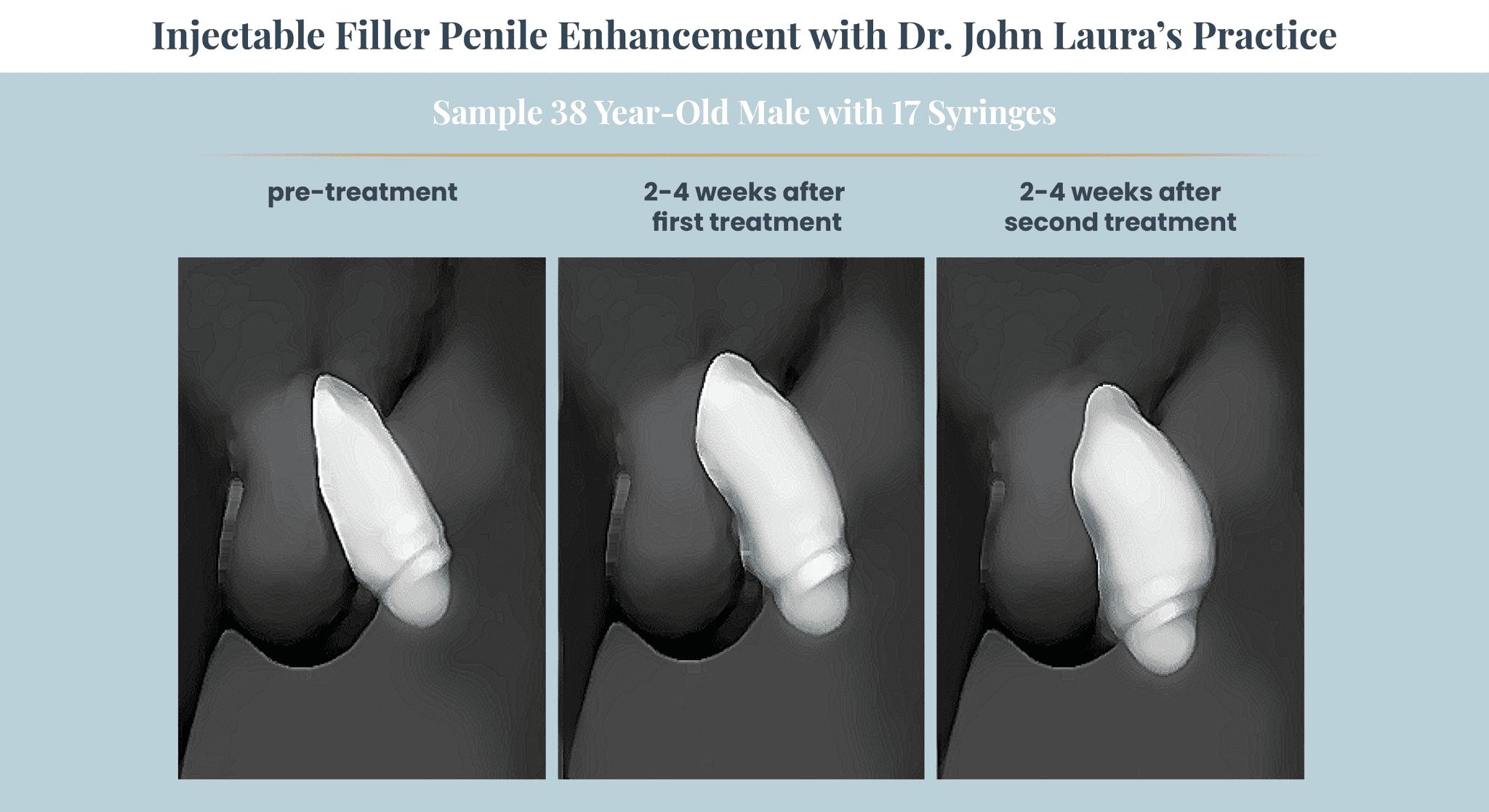 Male Genital Enhancement Options